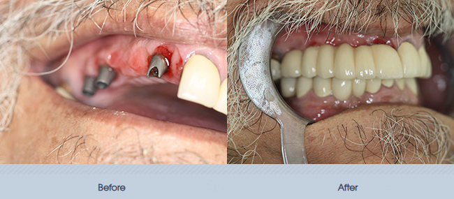 Single and Multiple Implant Restorations