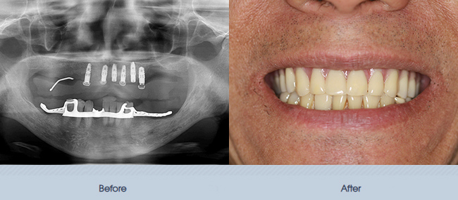 Full Mouth Implants and Fixed Dentures